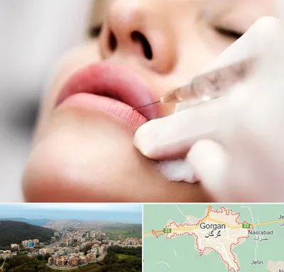 کلینیک تزریق ژل لب در گرگان