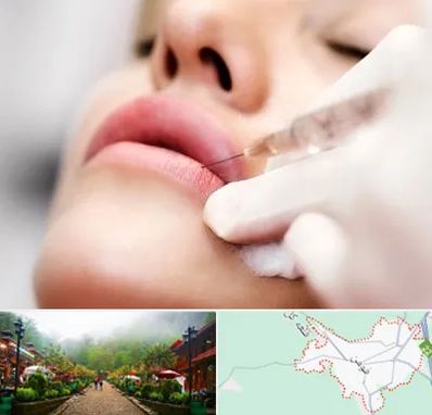 کلینیک تزریق ژل لب در فومن