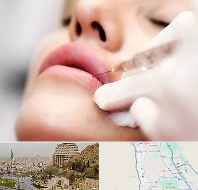 کلینیک تزریق ژل لب در فرهنگ شهر شیراز