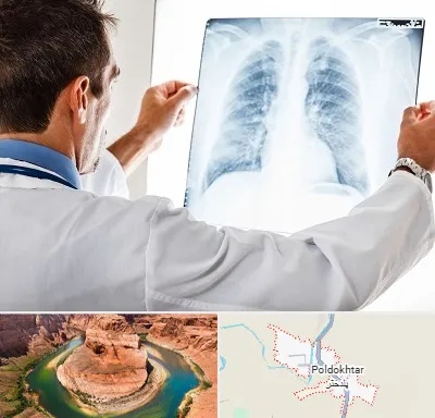 دکتر متخصص ریه در پلدختر