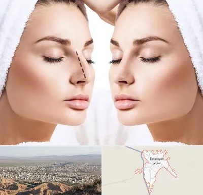 عمل بینی در اسفراین