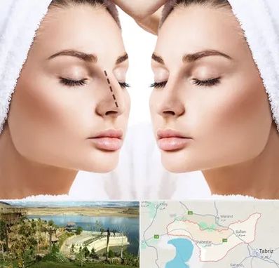 عمل بینی در شبستر