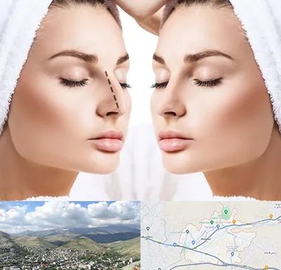 عمل بینی در رودهن