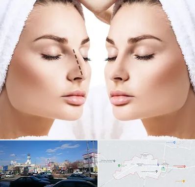 عمل بینی در ماهدشت کرج