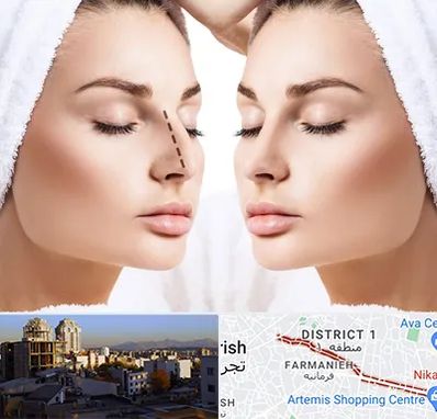 عمل بینی در فرمانیه