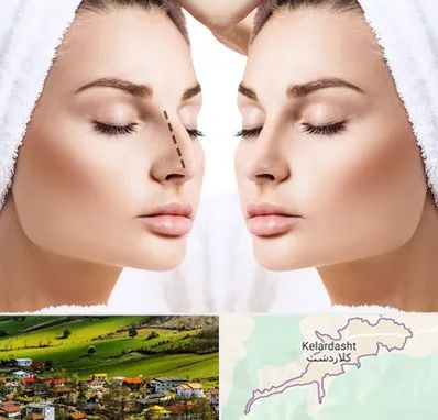 عمل بینی در کلاردشت