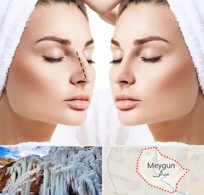 عمل بینی در میگون