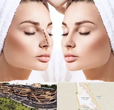 عمل بینی در شاهین شهر