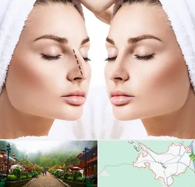 عمل بینی در فومن