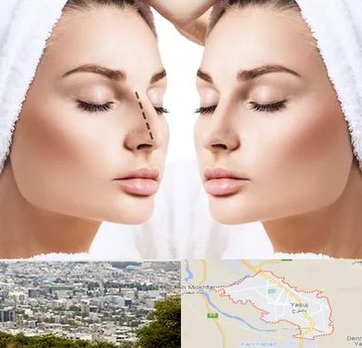 عمل بینی در یاسوج