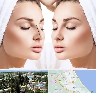 عمل بینی در رودسر