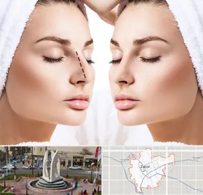 عمل بینی در زابل