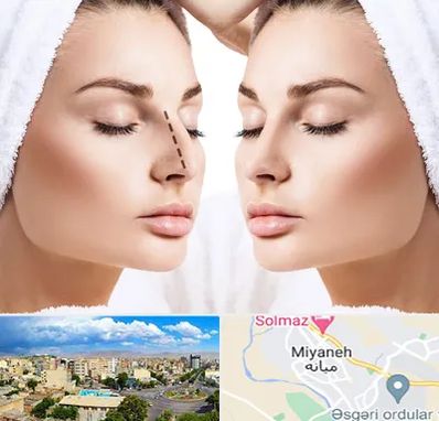 عمل بینی در میانه