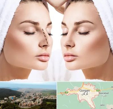عمل بینی در گرگان