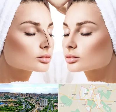 عمل بینی در شهریار