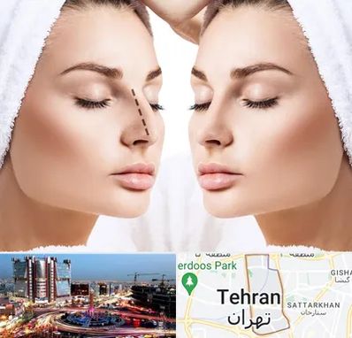 عمل بینی در صادقیه