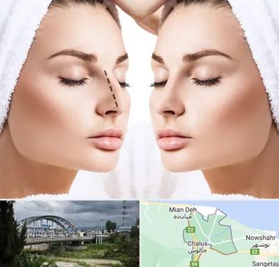 عمل بینی در چالوس