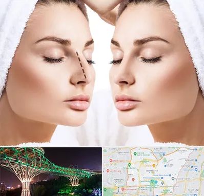 عمل بینی در منطقه 3 تهران