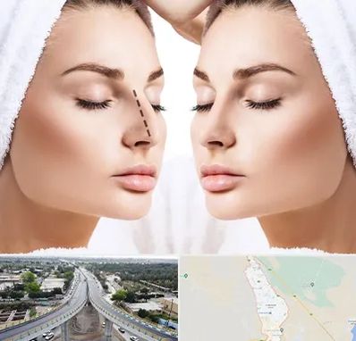 عمل بینی در اندیمشک