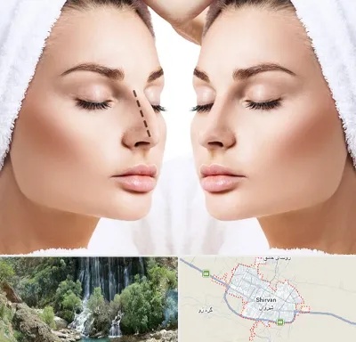 عمل بینی در شیروان