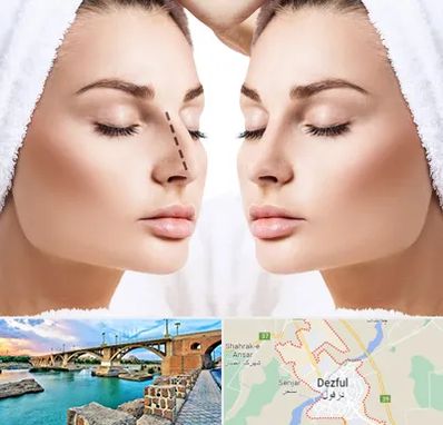 عمل بینی در دزفول