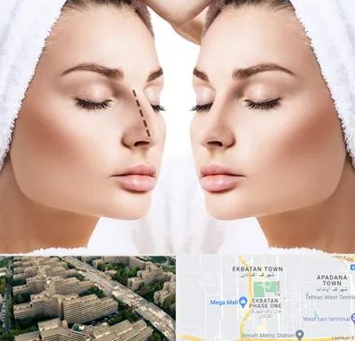 عمل بینی در اکباتان