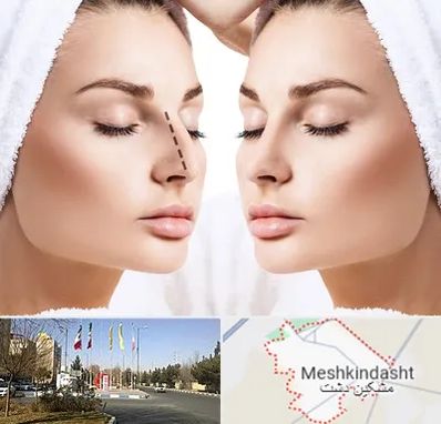 عمل بینی در مشکین دشت