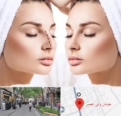 عمل بینی در ولیعصر شهریار