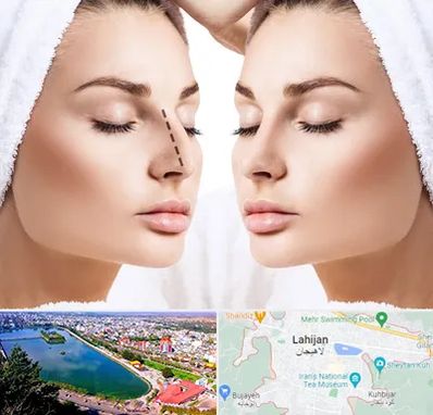 عمل بینی در لاهیجان