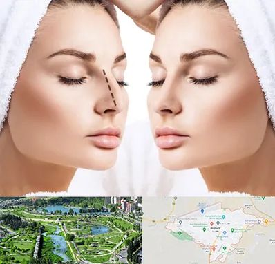 عمل بینی در بجنورد