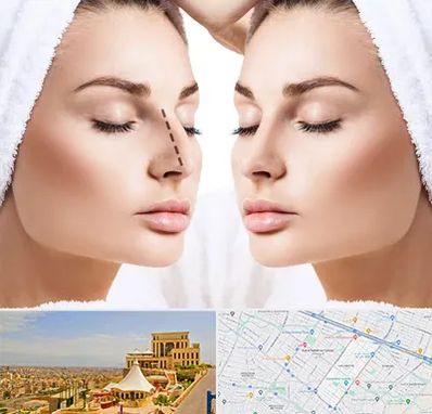 عمل بینی در هاشمیه مشهد