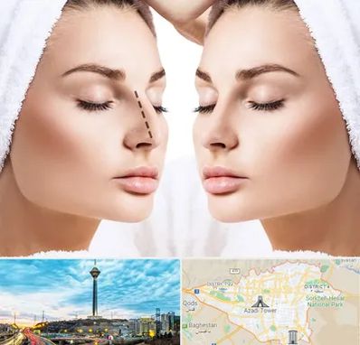 عمل بینی در تهران