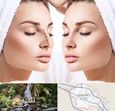 عمل بینی در الیگودرز