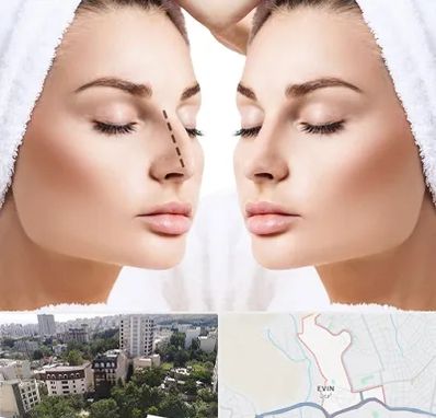 عمل بینی در اوین