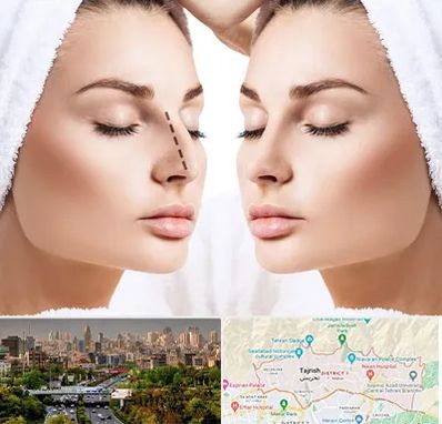 عمل بینی در منطقه 1 تهران