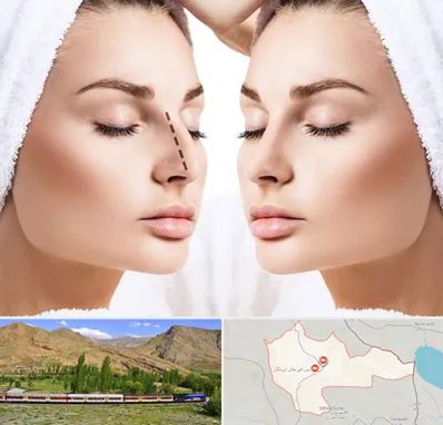 عمل بینی در خاش