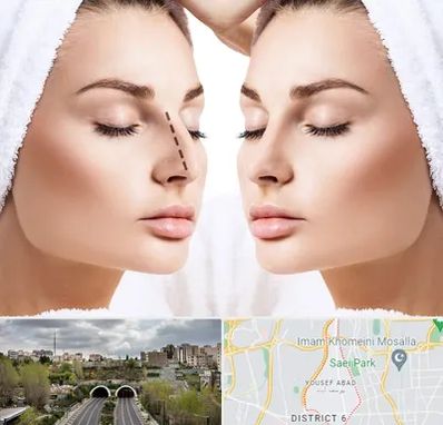 عمل بینی در یوسف آباد