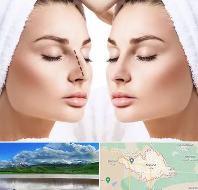 عمل بینی در مرند