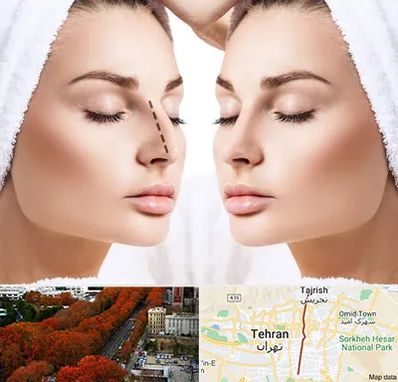 عمل بینی در ولیعصر