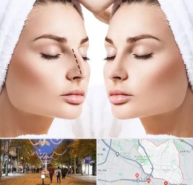 عمل بینی در ولیعصر ارومیه