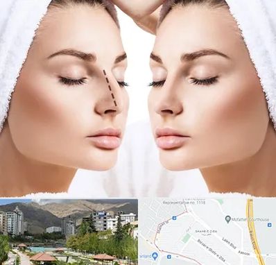 عمل بینی در شهر زیبا