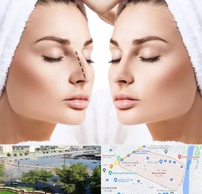 عمل بینی در گلستان اهواز