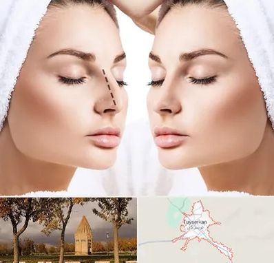 عمل بینی در تویسرکان