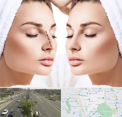 عمل بینی در منطقه 17 تهران