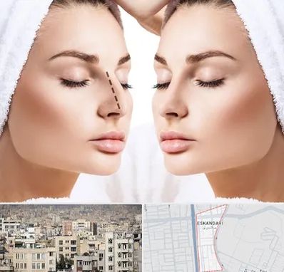 عمل بینی در اسکندری