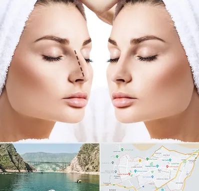 عمل بینی در ایلام