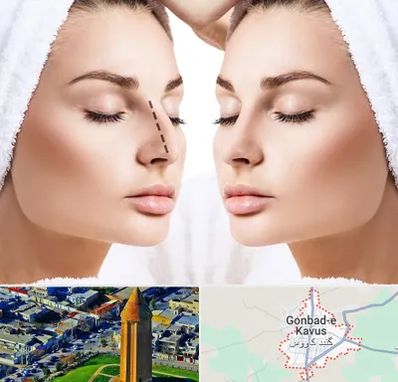 عمل بینی در گنبد کاووس