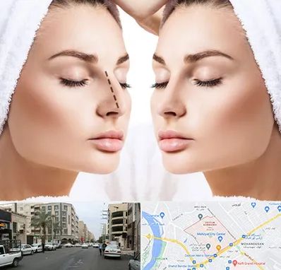 عمل بینی در زیتون کارمندی اهواز