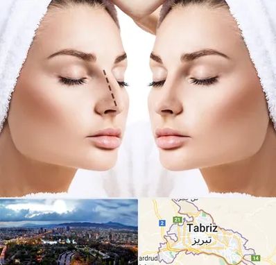عمل بینی در تبریز