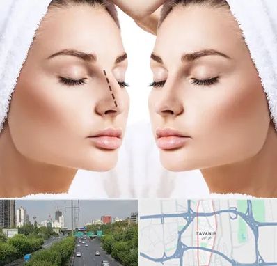 عمل بینی در توانیر